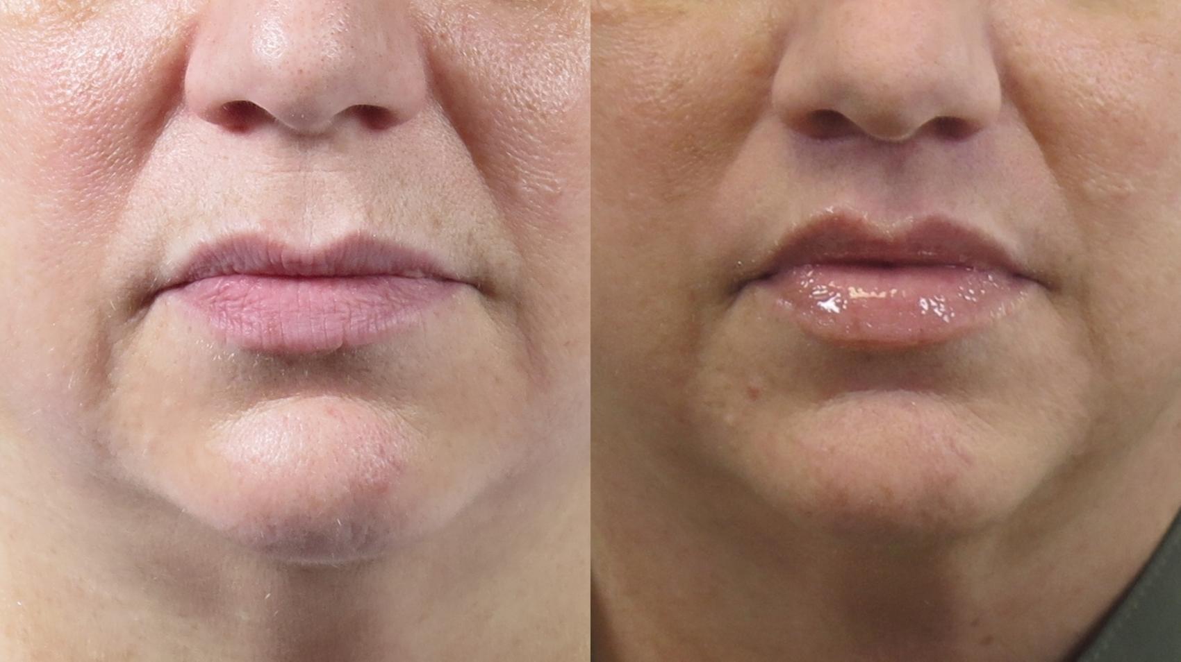 Lip Lift Case 1537 Before & After Left Side | Paramus, New Jersey | Parker Center for Plastic Surgery