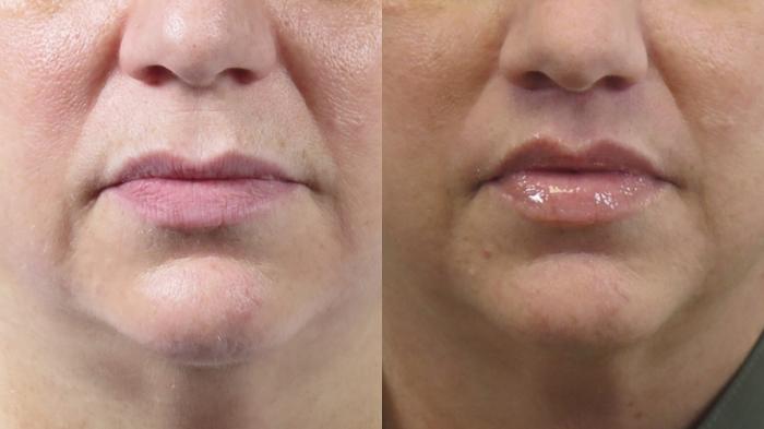 Lip Lift Case 1537 Before & After Left Side | Paramus, New Jersey | Parker Center for Plastic Surgery