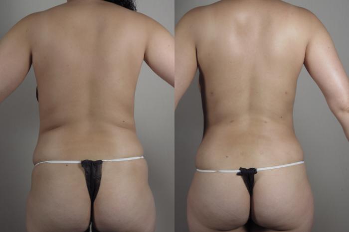 Liposuction Case 1030 Before & After Back | Paramus, New Jersey | Parker Center for Plastic Surgery