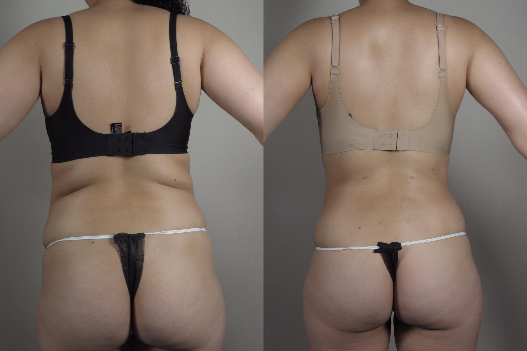 Liposuction Case 1030 Before & After Back w bra | Paramus, New Jersey | Parker Center for Plastic Surgery