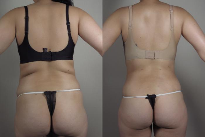 Liposuction Case 1030 Before & After Back w bra | Paramus, New Jersey | Parker Center for Plastic Surgery