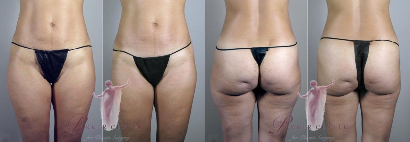 Liposuction Case 1102 Before & After Front | Paramus, New Jersey | Parker Center for Plastic Surgery