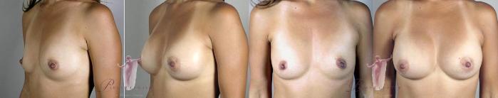 Liposuction Case 1102 Before & After Left Side | Paramus, New Jersey | Parker Center for Plastic Surgery