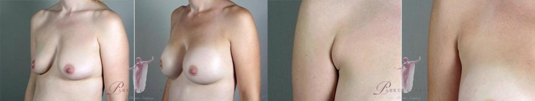 Breast Augmentation Case 1103 Before & After Front | Paramus, New Jersey | Parker Center for Plastic Surgery