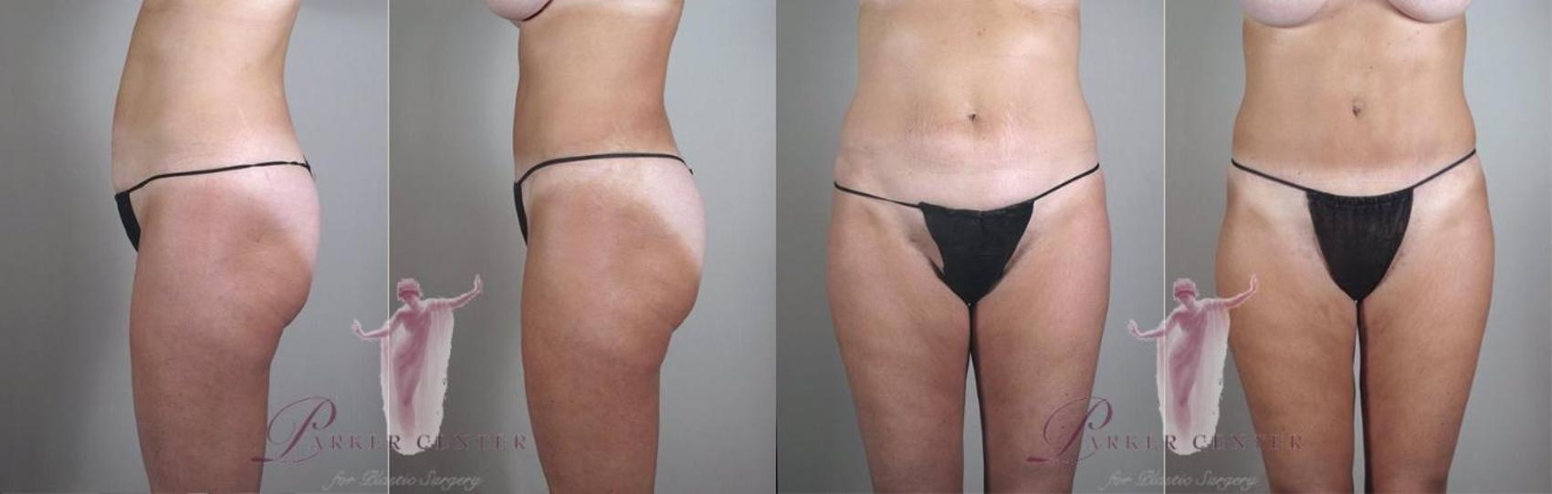 Liposuction Case 1117 Before & After Front | Paramus, New Jersey | Parker Center for Plastic Surgery