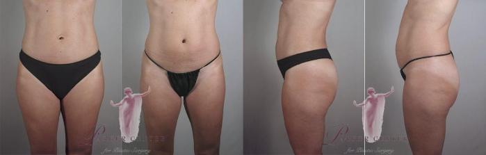 Liposuction Case 1119 Before & After Front | Paramus, New Jersey | Parker Center for Plastic Surgery