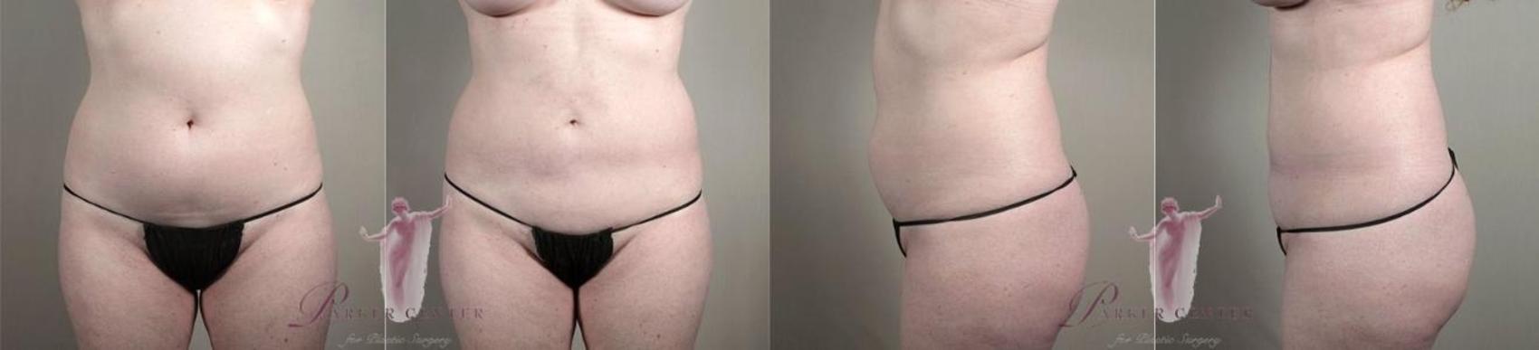 Liposuction Case 1123 Before & After Front | Paramus, New Jersey | Parker Center for Plastic Surgery