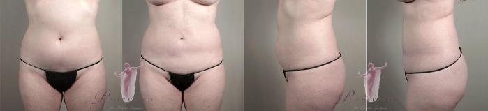 Liposuction Case 1123 Before & After Front | Paramus, New Jersey | Parker Center for Plastic Surgery