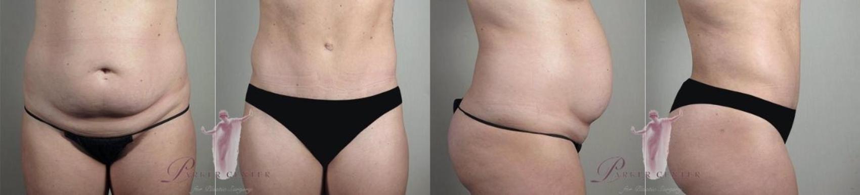 Liposuction Case 1126 Before & After Front | Paramus, New Jersey | Parker Center for Plastic Surgery