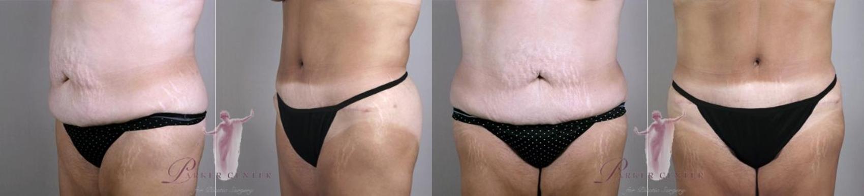 Liposuction Case 1128 Before & After Front | Paramus, New Jersey | Parker Center for Plastic Surgery