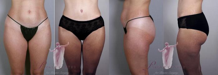 Liposuction Case 1129 Before & After Front | Paramus, New Jersey | Parker Center for Plastic Surgery