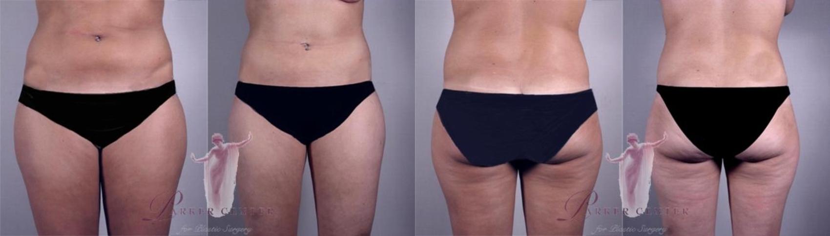 Liposuction Case 1155 Before & After Front | Paramus, New Jersey | Parker Center for Plastic Surgery