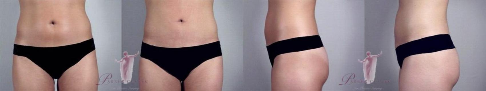 Liposuction Case 1157 Before & After Front | Paramus, New Jersey | Parker Center for Plastic Surgery