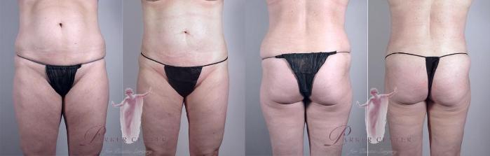 Liposuction Case 1161 Before & After Front | Paramus, New Jersey | Parker Center for Plastic Surgery