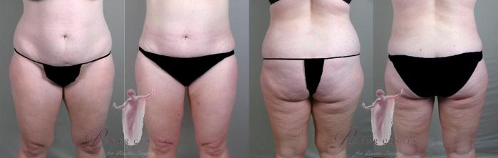 Liposuction Case 1162 Before & After Front | Paramus, New Jersey | Parker Center for Plastic Surgery