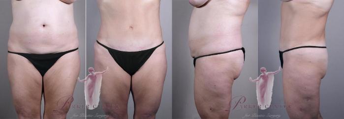 Liposuction Case 1163 Before & After Front | Paramus, New Jersey | Parker Center for Plastic Surgery