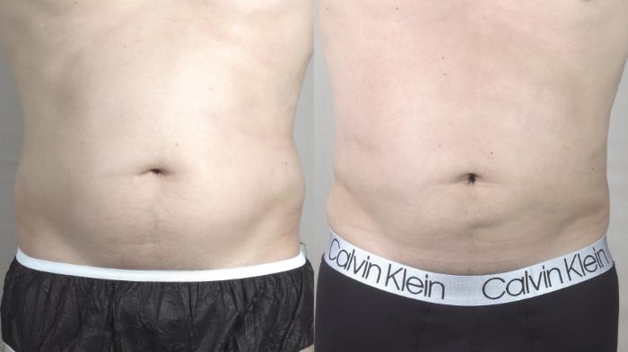 Liposuction Case 1222 Before & After View #1  | Paramus, New Jersey | Parker Center for Plastic Surgery
