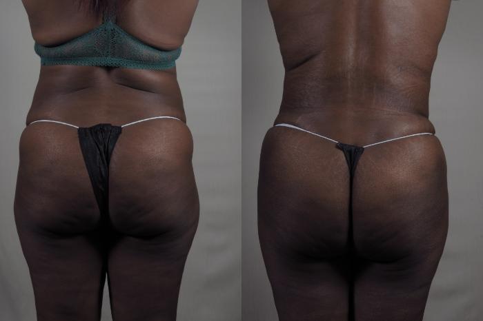 Liposuction Case 1327 Before & After Back | Paramus, New Jersey | Parker Center for Plastic Surgery
