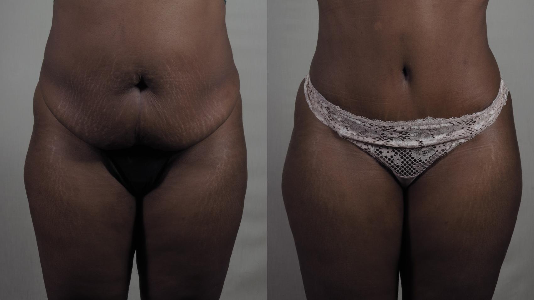 Liposuction Case 1327 Before & After Front | Paramus, New Jersey | Parker Center for Plastic Surgery