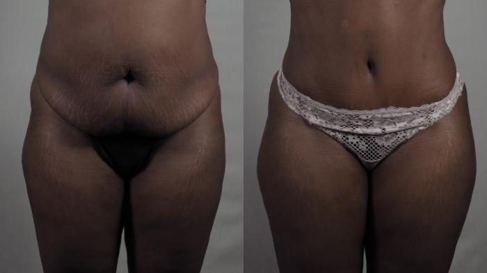 Liposuction Case 1327 Before & After Front | Paramus, New Jersey | Parker Center for Plastic Surgery