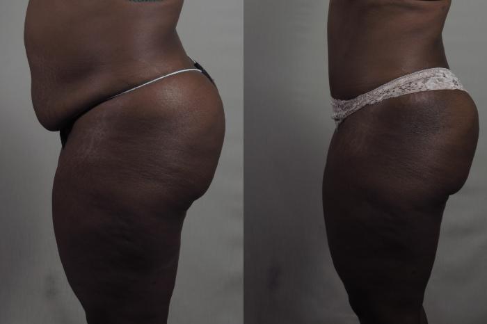 Liposuction Case 1327 Before & After Left Side | Paramus, New Jersey | Parker Center for Plastic Surgery