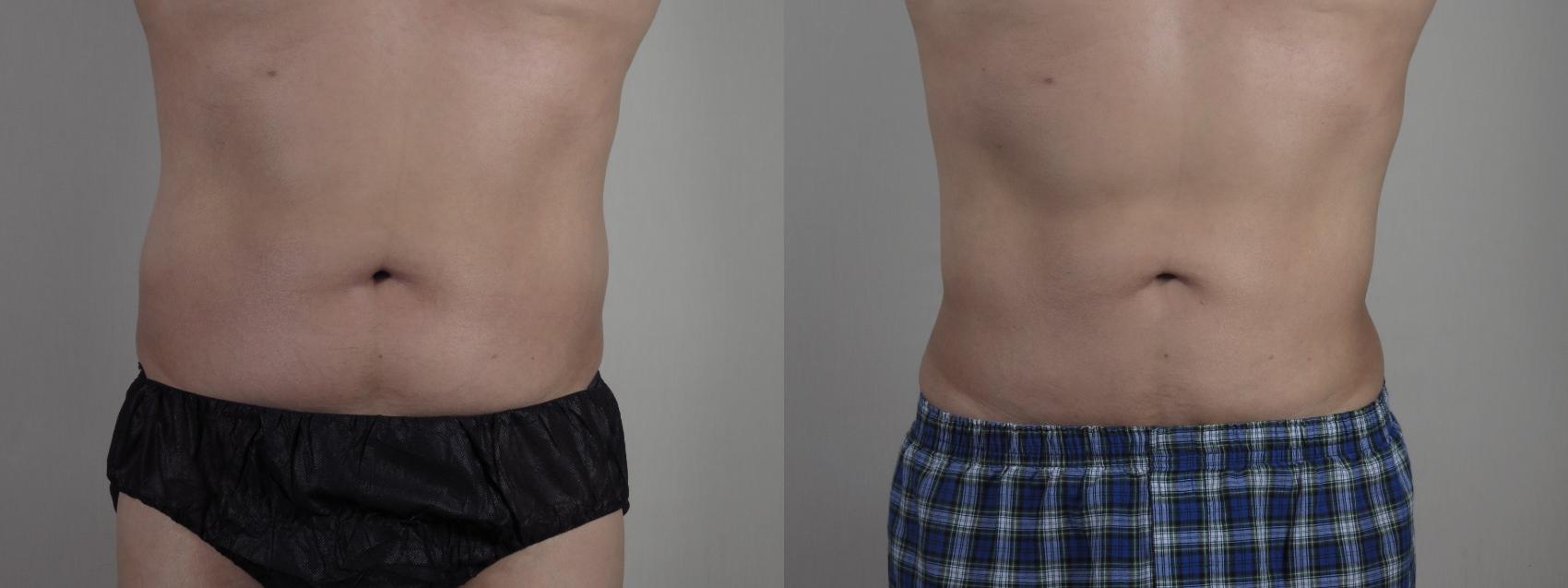 Liposuction Case 1337 Before & After Front | Paramus, New Jersey | Parker Center for Plastic Surgery