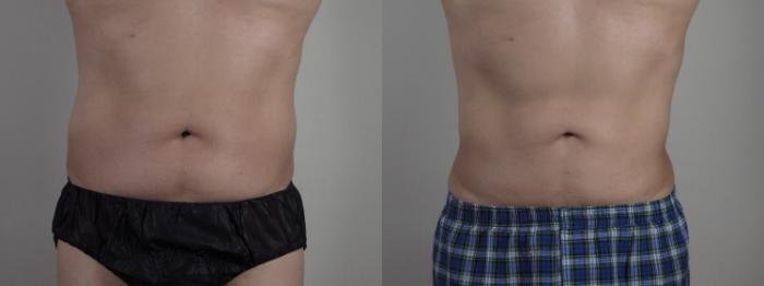 Liposuction Case 1337 Before & After Front | Paramus, New Jersey | Parker Center for Plastic Surgery