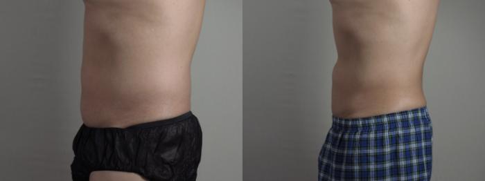 Liposuction Case 1337 Before & After Left Side | Paramus, New Jersey | Parker Center for Plastic Surgery