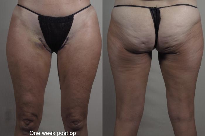 Liposuction Case 1365 Before & After 1 week  | Paramus, New Jersey | Parker Center for Plastic Surgery