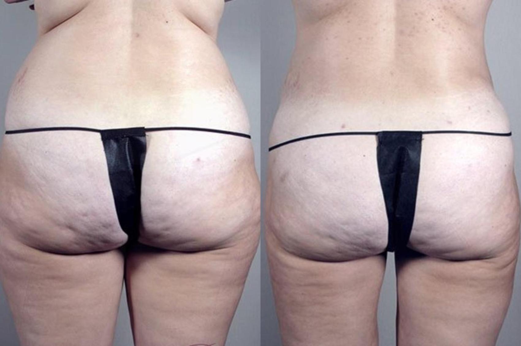 Liposuction Case 1382 Before & After Back | Paramus, New Jersey | Parker Center for Plastic Surgery