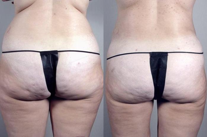 Liposuction Case 1382 Before & After Back | Paramus, New Jersey | Parker Center for Plastic Surgery