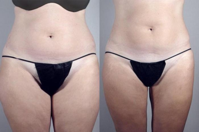 Liposuction Case 1382 Before & After Front | Paramus, New Jersey | Parker Center for Plastic Surgery