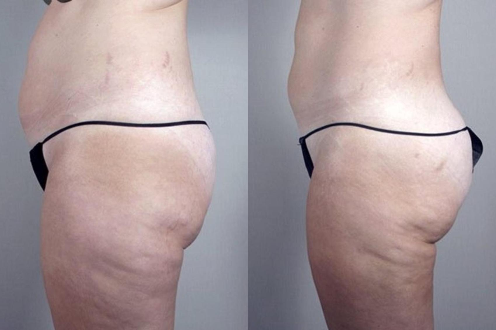 Liposuction Case 1382 Before & After Left Side | Paramus, New Jersey | Parker Center for Plastic Surgery