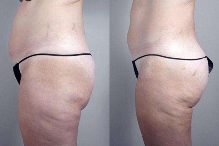 Liposuction Case 1382 Before & After Left Side | Paramus, New Jersey | Parker Center for Plastic Surgery