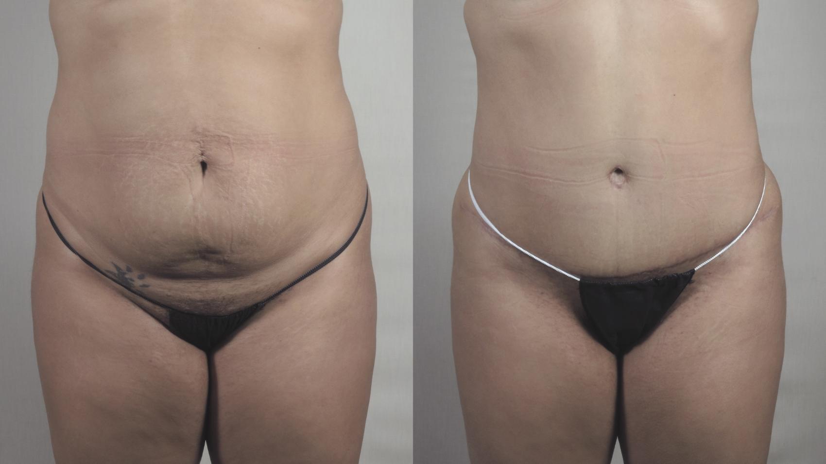 Liposuction Case 1519 Before & After Front | Paramus, New Jersey | Parker Center for Plastic Surgery