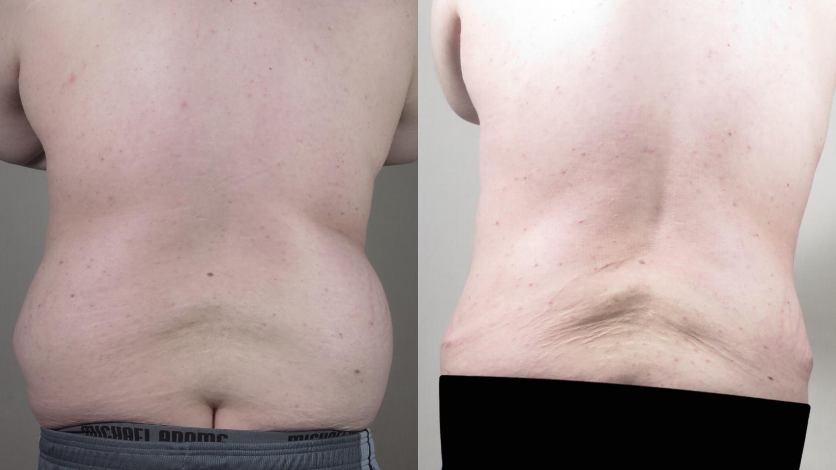 Liposuction Case 1541 Before & After Back | Paramus, New Jersey | Parker Center for Plastic Surgery