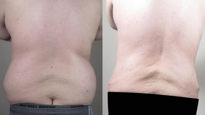 Liposuction Case 1541 Before & After Back | Paramus, New Jersey | Parker Center for Plastic Surgery