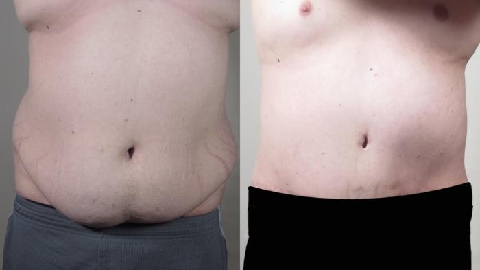 Liposuction Case 1541 Before & After Front | Paramus, New Jersey | Parker Center for Plastic Surgery
