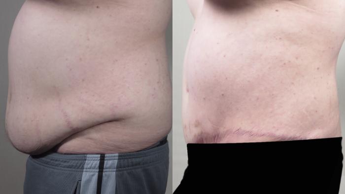 Liposuction Case 1541 Before & After Left Side | Paramus, New Jersey | Parker Center for Plastic Surgery
