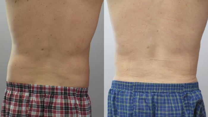 Liposuction Case 1653 Before & After Back | Paramus, New Jersey | Parker Center for Plastic Surgery