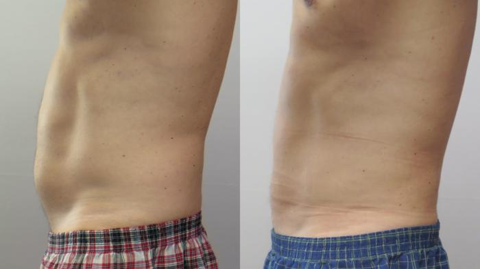 Liposuction Case 1653 Before & After left side 1 | Paramus, New Jersey | Parker Center for Plastic Surgery