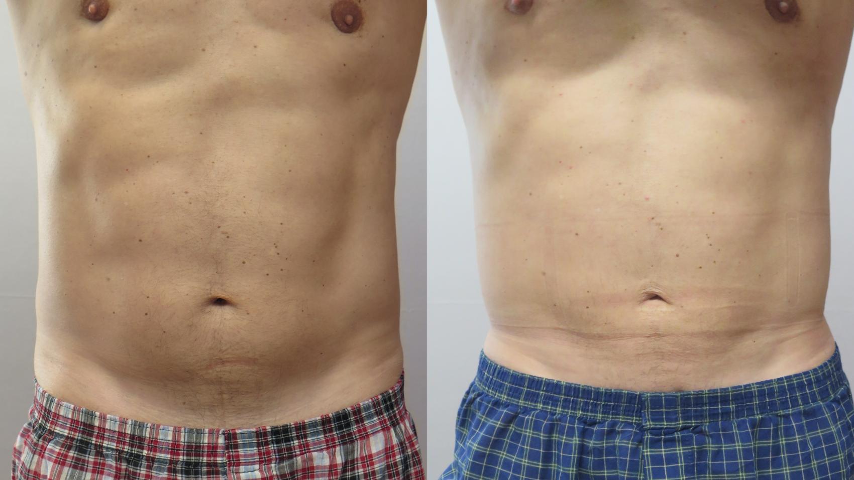 Liposuction Case 1653 Before & After Left Side | Paramus, New Jersey | Parker Center for Plastic Surgery