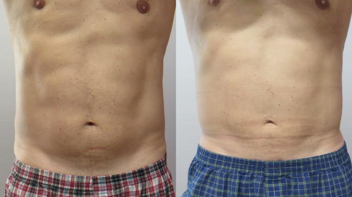 Liposuction Case 1653 Before & After Left Side | Paramus, New Jersey | Parker Center for Plastic Surgery