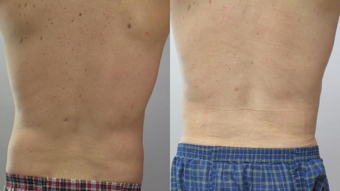 Liposuction Case 1673 Before & After Back | Paramus, New Jersey | Parker Center for Plastic Surgery