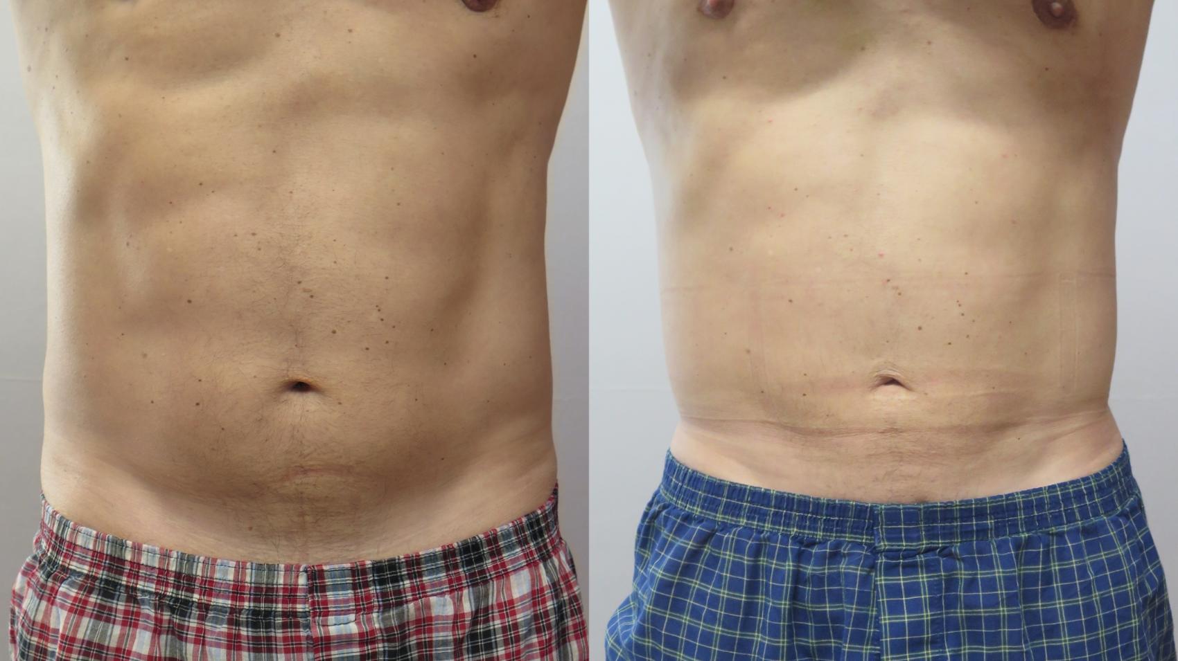 Liposuction Case 1673 Before & After Front | Paramus, New Jersey | Parker Center for Plastic Surgery