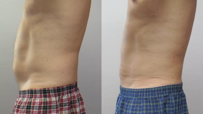 Liposuction Case 1673 Before & After Left Side | Paramus, New Jersey | Parker Center for Plastic Surgery