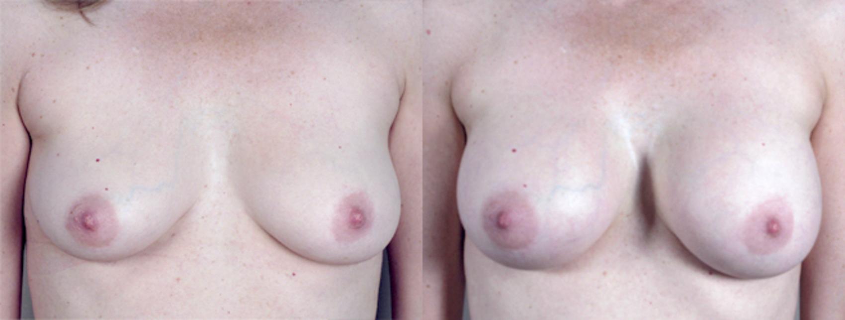 Liposuction Case 384 Before & After View #1 | Paramus, New Jersey | Parker Center for Plastic Surgery