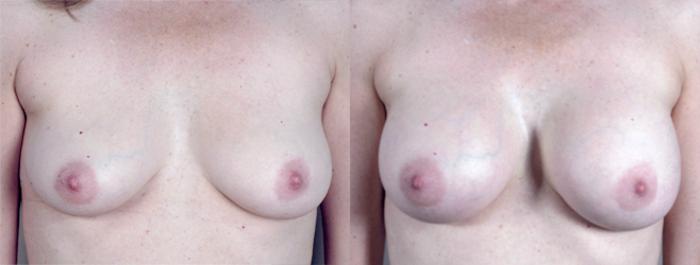 Liposuction Case 384 Before & After View #1 | Paramus, New Jersey | Parker Center for Plastic Surgery