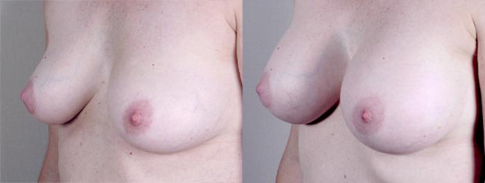 Liposuction Case 384 Before & After View #2 | Paramus, New Jersey | Parker Center for Plastic Surgery