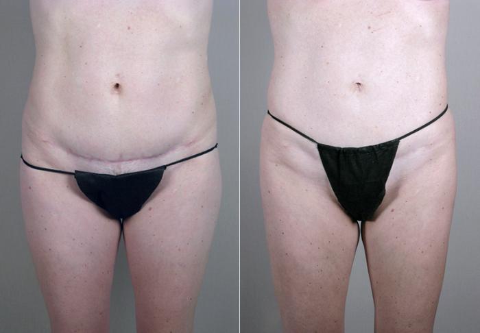 Liposuction Case 384 Before & After View #3 | Paramus, New Jersey | Parker Center for Plastic Surgery